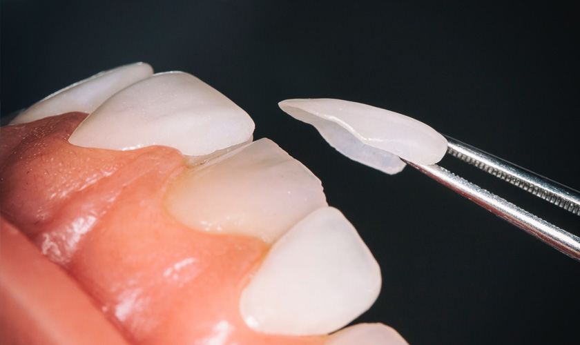 Porcelain veneer maximize the teeth protection, ensure a comprehensive aesthetics