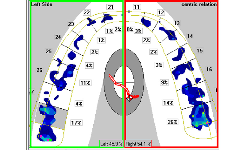 The T-Scan occlusal analysis system brings great benefits in dental treatment such as cosmetic porcelain teeth, implants, etc.