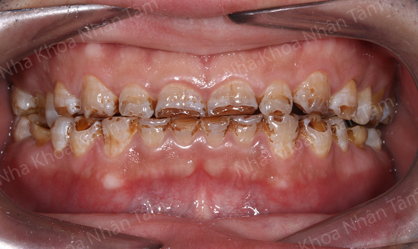 Severe discoloration should be treated with crowns