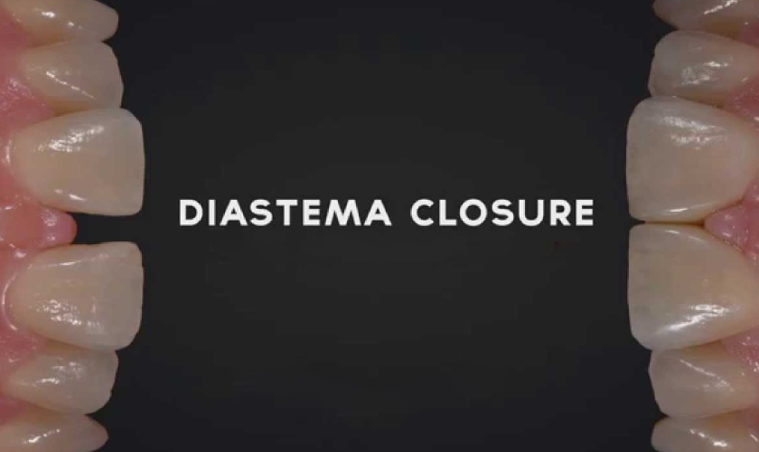 400Pcs Cunei Di Plastica Dentali, Cunei Di Fissaggio Monouso - Foto 10