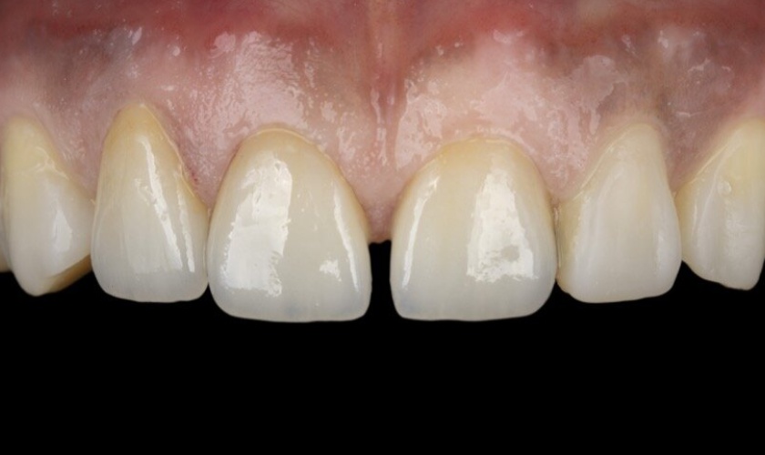 Veneer for diastema closure