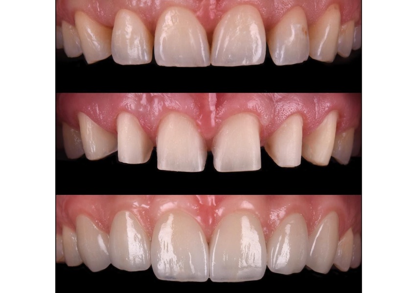 Veneer for diastema closure