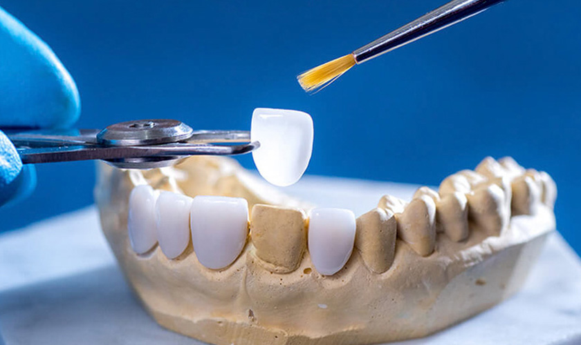 porcelain veneer