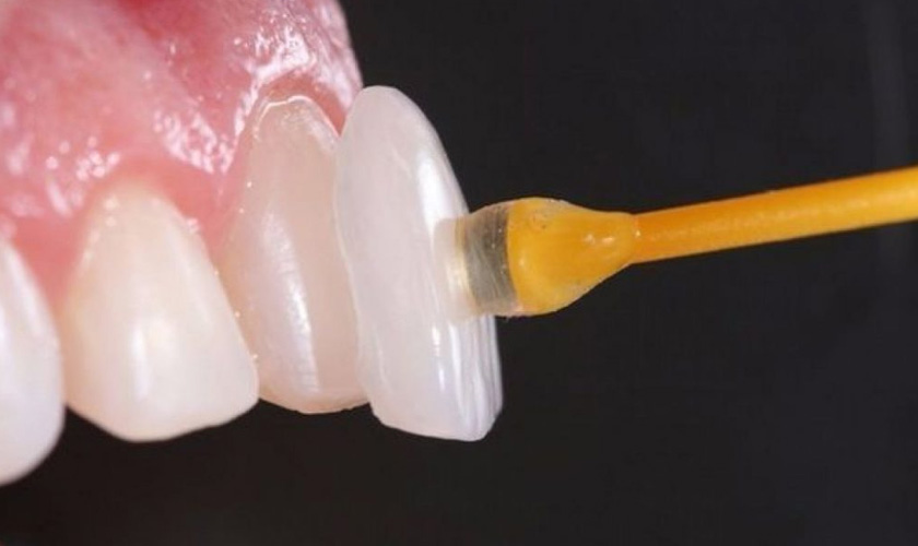 Veneer porcelain panels with optimum thickness (0.5mm - 0.6mm)