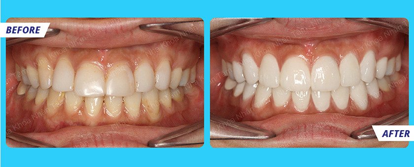 Before and after Veneer porcelain