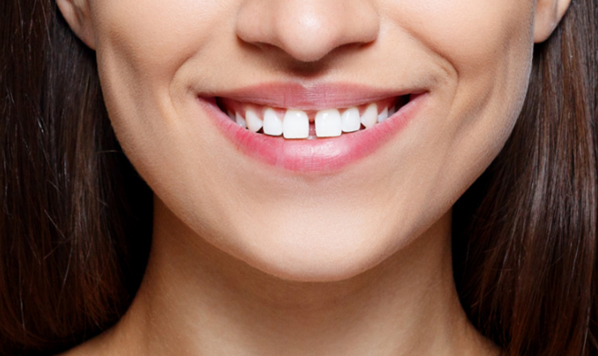 Porcelain Veneer - Treating Diastema