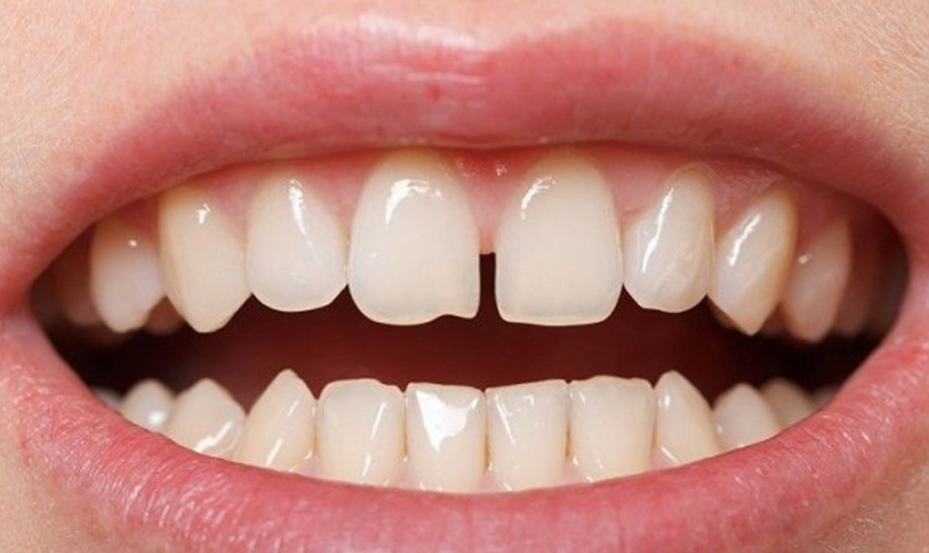 porcelain veneer