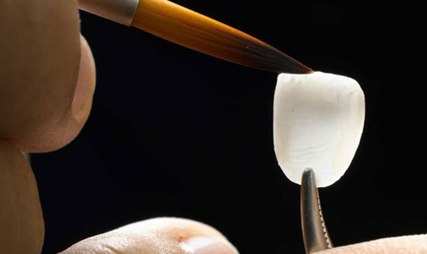 porcelain veneer