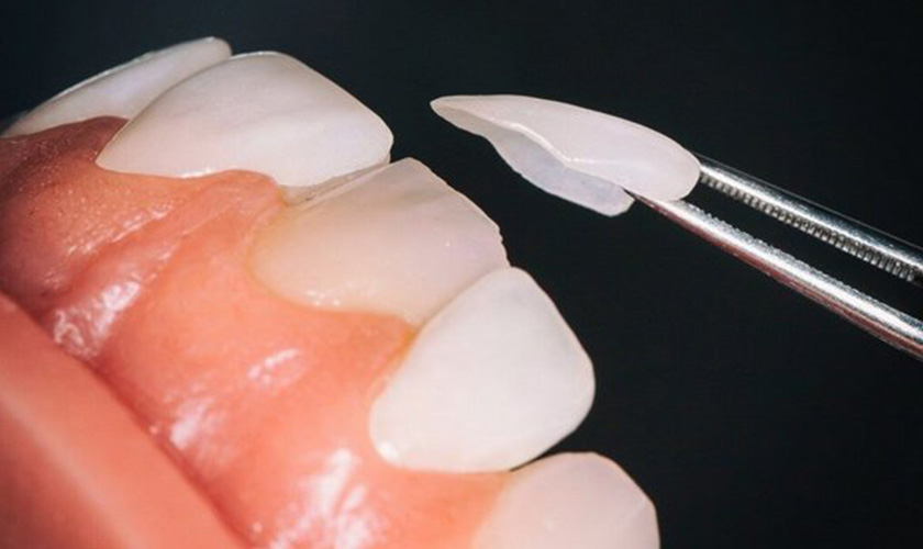 porcelain veneer