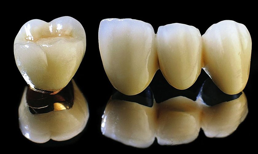 titanium crown