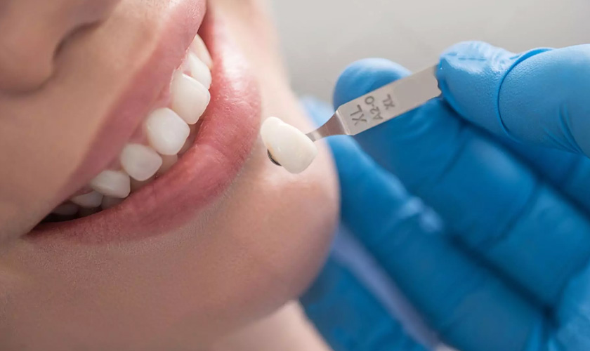 Cosmetic Porcelain Crown in Vietnam: The Ultimate Smile Transformation 5 What Makes Cosmetic Crowns in Vietnam So Popular?