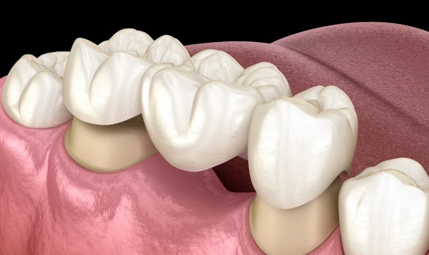 What are dental bridges?