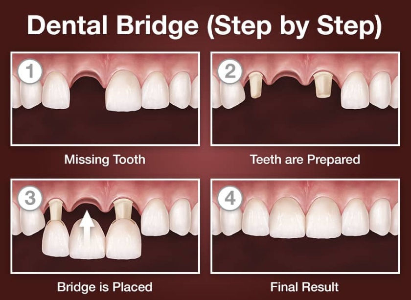 What are dental bridges?