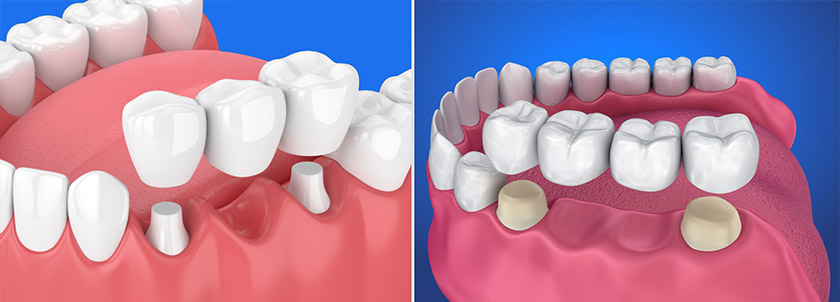 What are dental bridges?