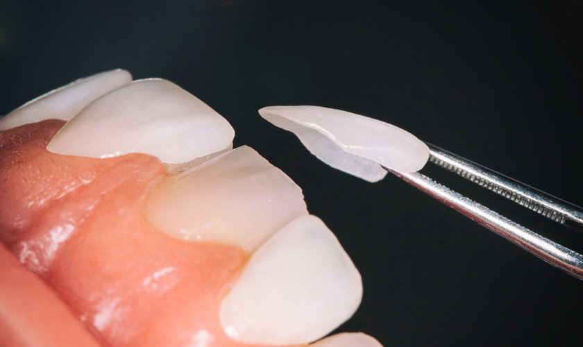 Porcelain Veneer requires quite a few teeth grinding