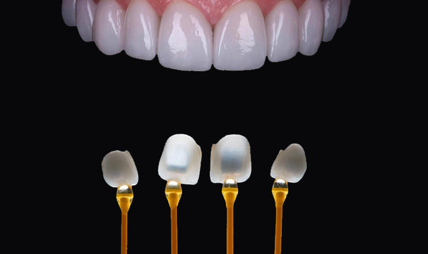 High aesthetics is one of the outstanding features of Veneer porcelain