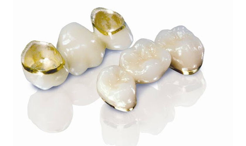 A precious metal crown is designed with precious metal in the inside and porcelain layers in the outside