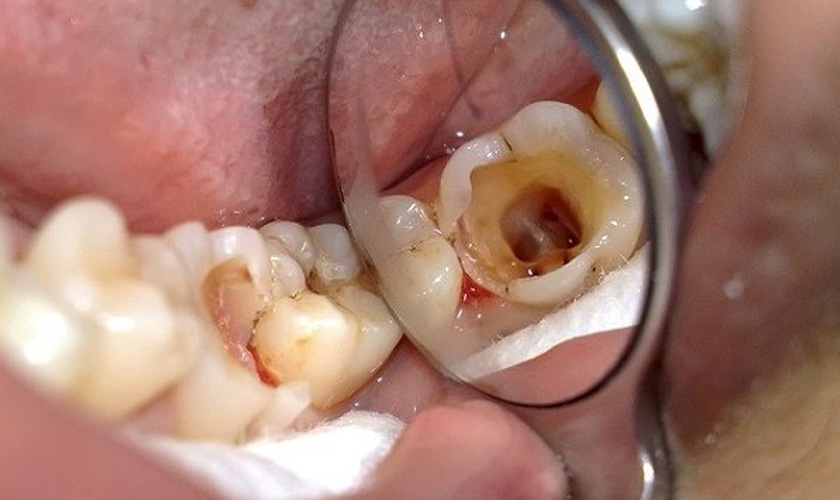 Regular metal crowns are often used to restore chipped, broken teeth, wide cavities, etc.