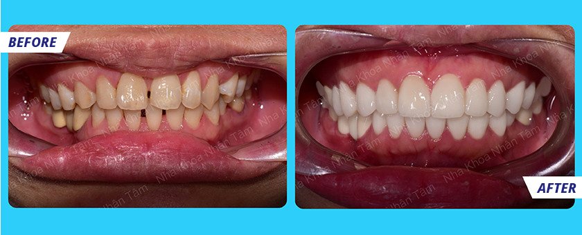 Suitable cases for Titanium crown treatment