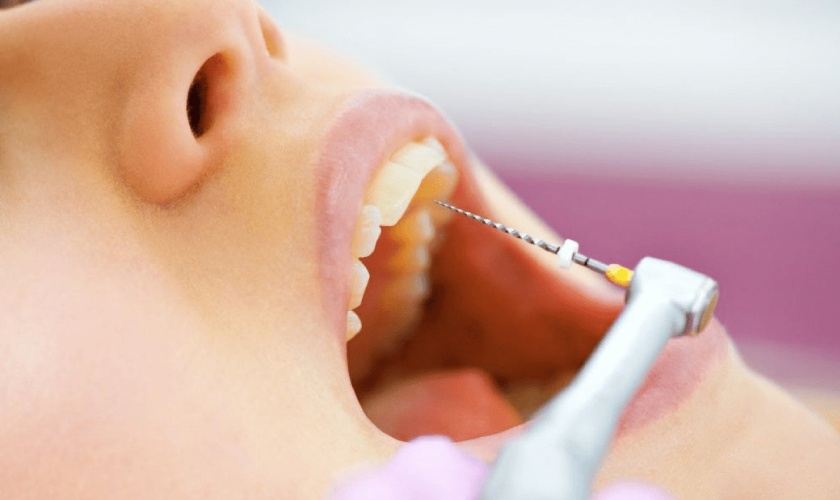 When should porcelain crowns have root canal treatment?