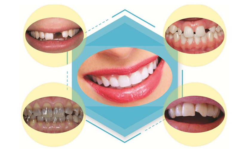 Aesthetic porcelain teeth are suitable for many cases of tinted teeth, broken, missing teeth,etc.