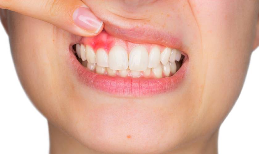 Pregnancy Gingivitis