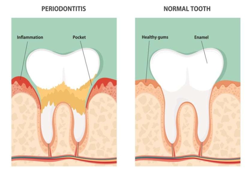 Periodontal Disease