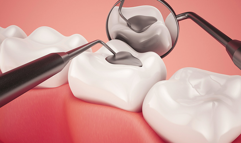 How much do dental fillings cost at Nhan Tam Dental?