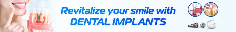 Dental Implants Hình: Dental Implants