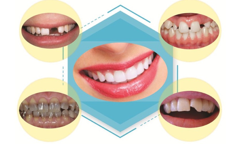 Cases for dental crown treatment