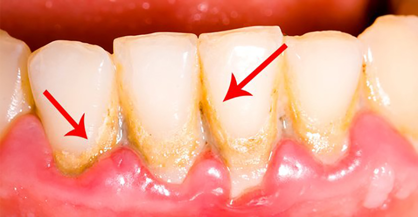 Poor oral hygiene will form plaque which will form tartar