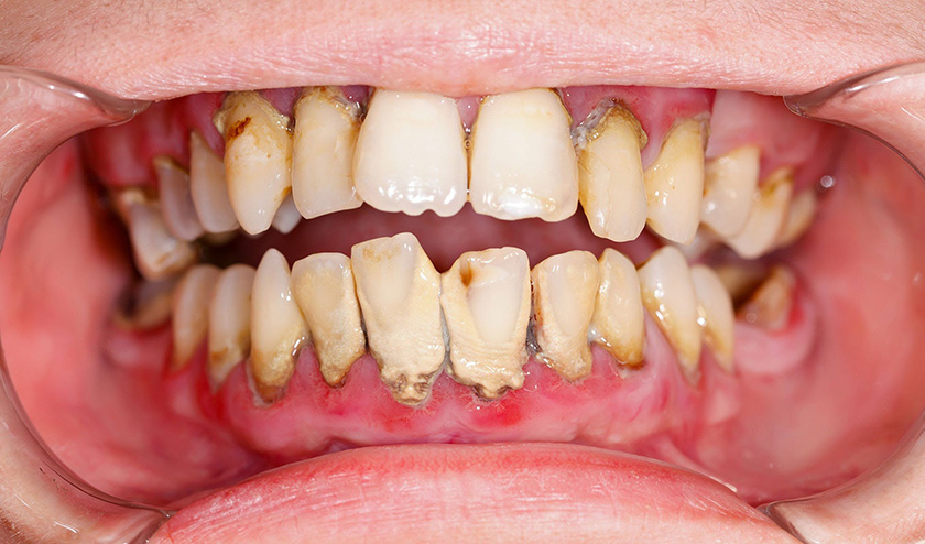 If gingivitis is not treated, the amount of tartar increased can lead to periodontal inflammation
