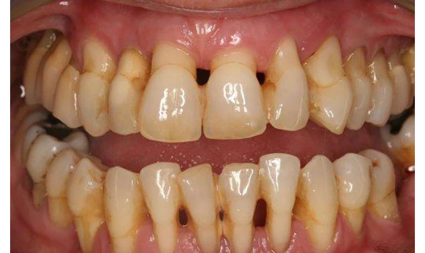 Harm of tartar