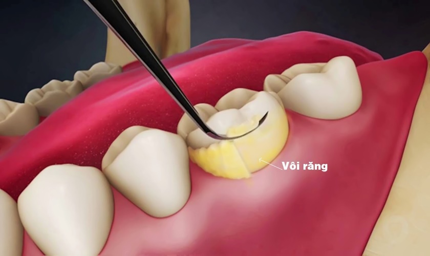 Why should you remove tartar?