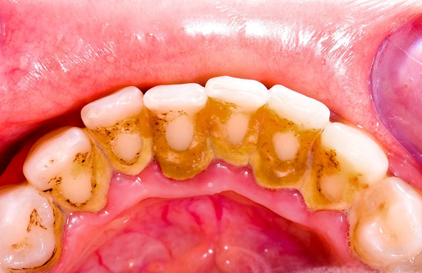 Tartar removal is essential to have healthy teeth