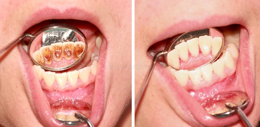 Tartar/plaque removal is recommended every six months to maintain the best dental health