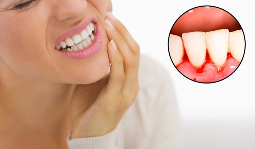 Một trong những biểu hiện thiếu vitamin K là chảy máu chân răng Một trong những biểu hiện thiếu vitamin K là chảy máu chân răng