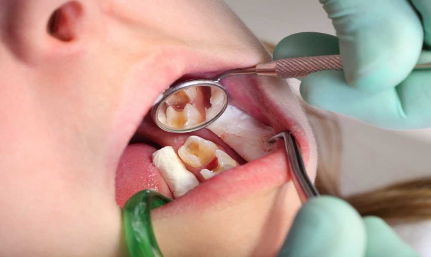 Avoiding pulpal death during fixed prosthodontic procedures