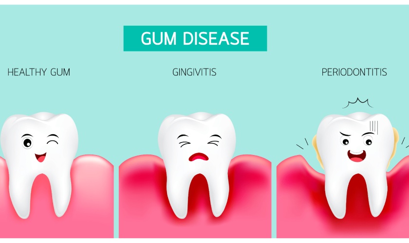 Chảy máu chân răng có thể do bệnh nha chu Chảy máu chân răng có thể do bệnh nha chu