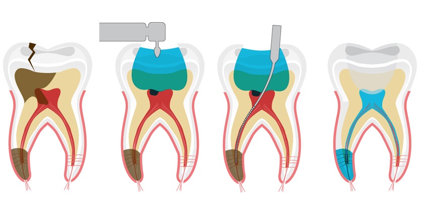 Pulp treatment procedure is performed with modern equipment