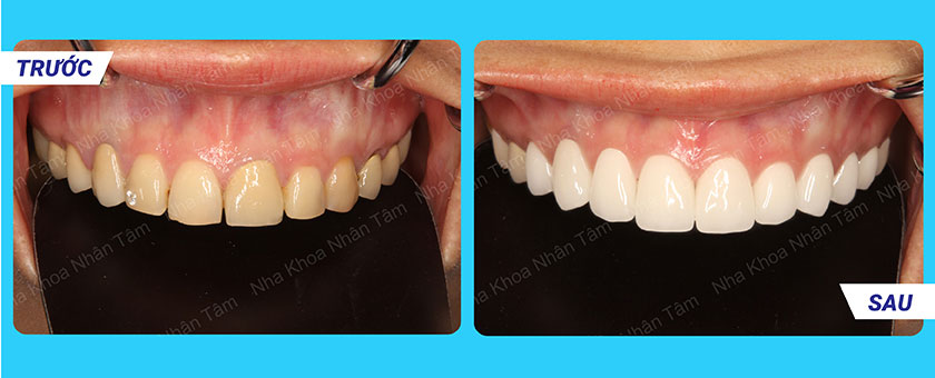 Digital Smile Design | Ani Dent Clinic