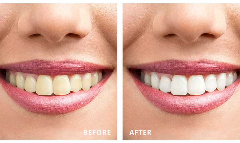The durability of teeth after whitening depends on each person's care