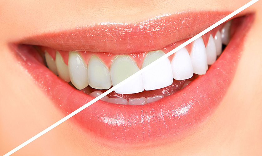 Caring for your teeth after whitening
