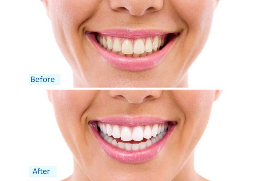Teeth before and after whitening