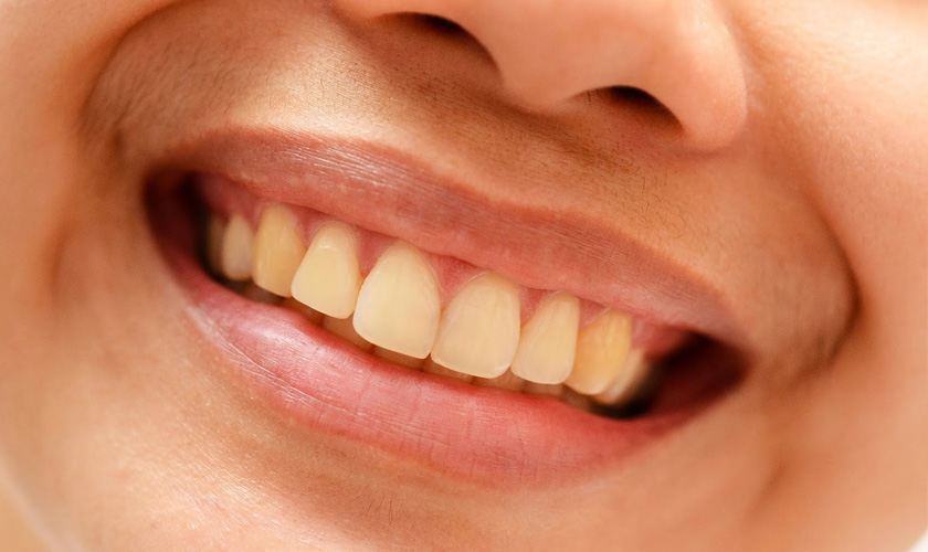 Causes of dark teeth