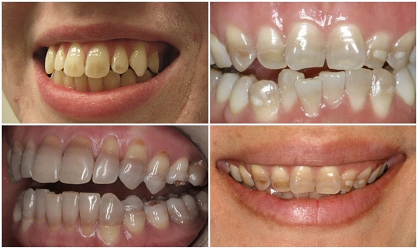 Teeth stained by tetracyclines