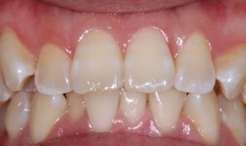 Fluoridated teeth