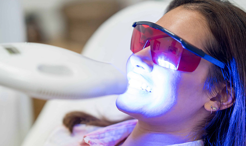 How long do laser teeth whitening results last?