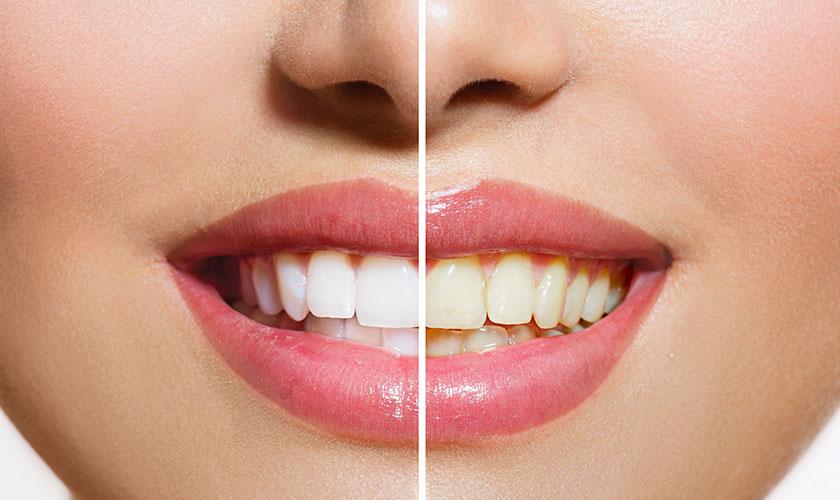 How to whiten teeth fast?
