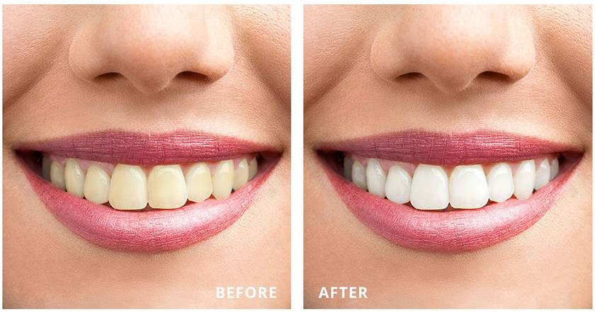 Laser Whitening brings bright white teeth